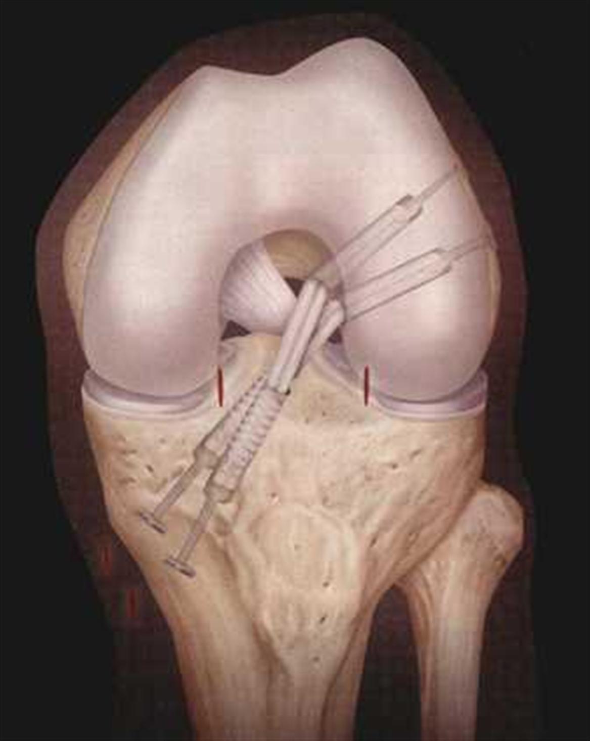 Doppelbündelrekonstruktion des Vorderen Kreuzbandes
